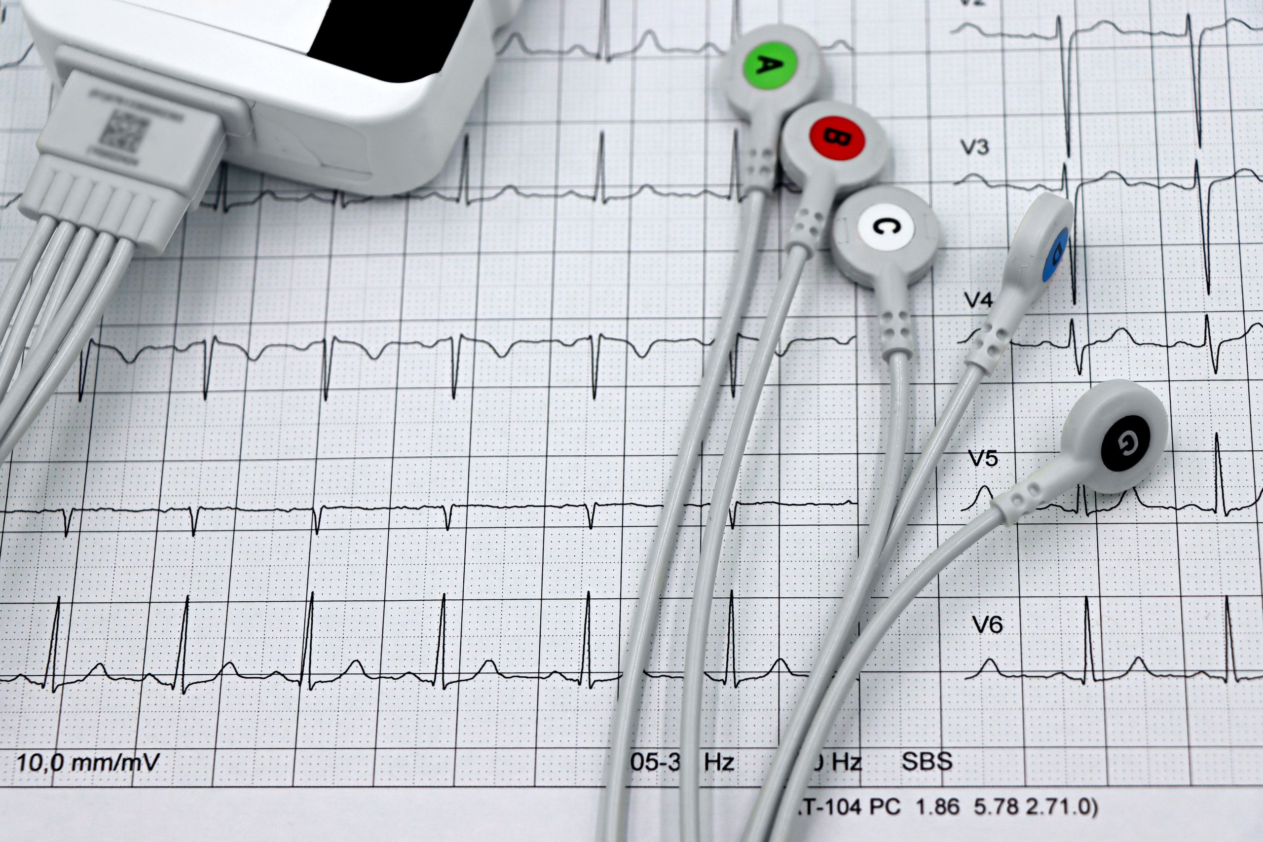An AI Tool Can Flag Hidden Heart Disease in Routine ECGs